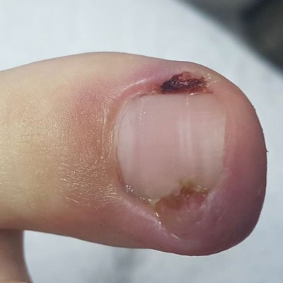 Infecção de unhas - Podomania